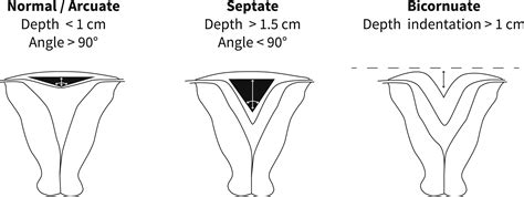 Uterine septum: a guideline - Fertility and Sterility