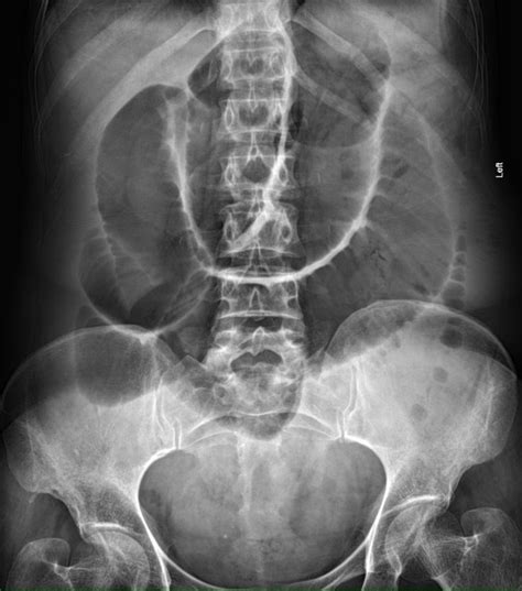 Plicae Circulares X Ray