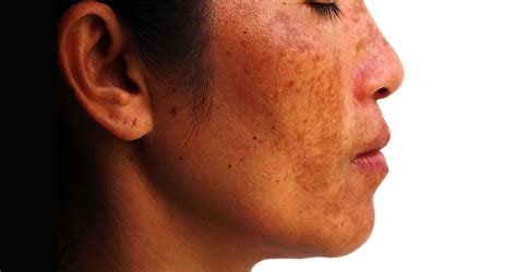 Melasma Treatment | Melasma Pigmentation | The Lifestyle Clinic