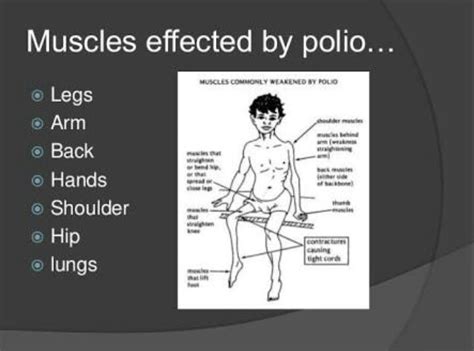 ENVIRONMENTAL HEALTH AND SAFETY ADVISOR'S BLOG: ABOUT POLIOMYELITIS ...