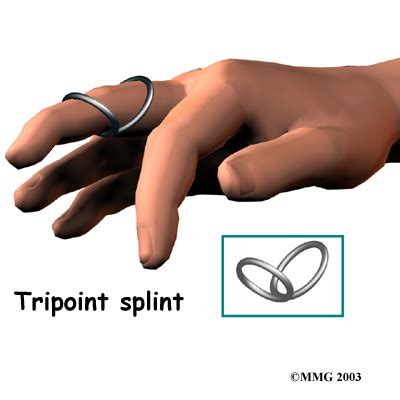 Physical Therapy in Baker County for Swan Neck Deformity of the Finger