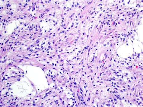 Pathology Outlines - Pilocytic astrocytoma