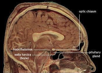 Tuber cinereum hamartoma - Alchetron, the free social encyclopedia