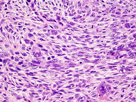 Malignant pleural mesothelioma subtypes