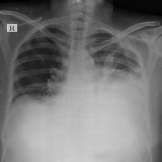 Chylous pleural fluid. | Download Scientific Diagram