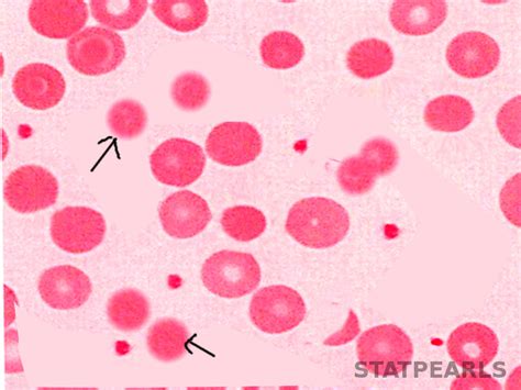 Hereditary Spherocytosis - StatPearls - NCBI Bookshelf