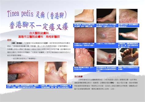 肌膚之親: Tinea pedis 足癬（香港腳） 香港腳不一定癢又癢