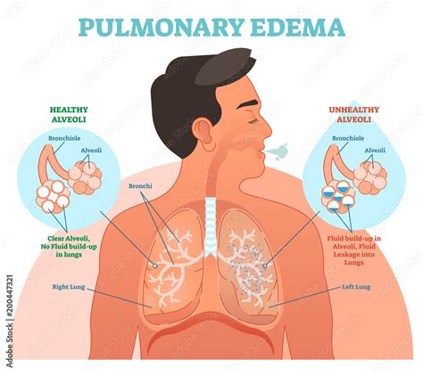 Pulmonary Edema Diagram