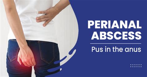 Perianal abscess – Causes, Symptoms, Risk factors, and Treatments