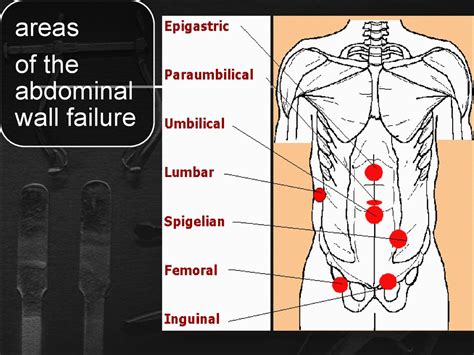 Abdominal wall hernia - презентация онлайн