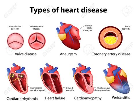 Coronary clipart 20 free Cliparts | Download images on Clipground 2024