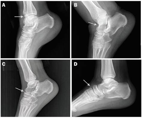 Medicina | Free Full-Text | Accessory Ossicles in the Region of the Foot and Ankle: An ...