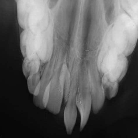 b: Maxillary occlusal view showing inverted mesiodens | Download ...