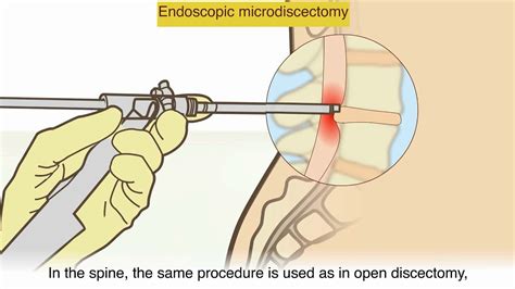 Herniated Disc Surgery Video