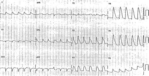 Dr. Smith's ECG Blog: "Shark Fin": A Deadly ECG Sign that you Must Know!