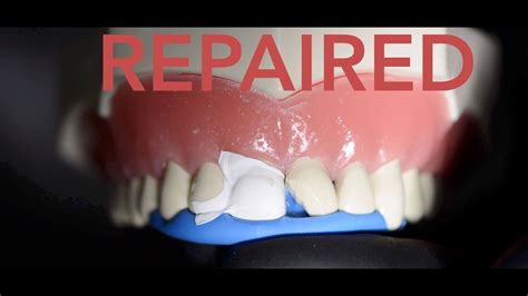 How To Fix A Broken Tooth Crown At Home | Review Home Co