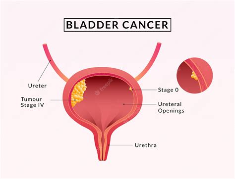 Bladder Cancer. Symptoms, Causes, Treatment. Line Icons Set - Clip Art ...