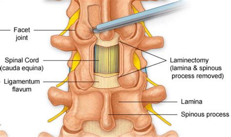 Laminectomy - Matthew D. Hepler, M.D. (Spine Surgeon Delray Beach)