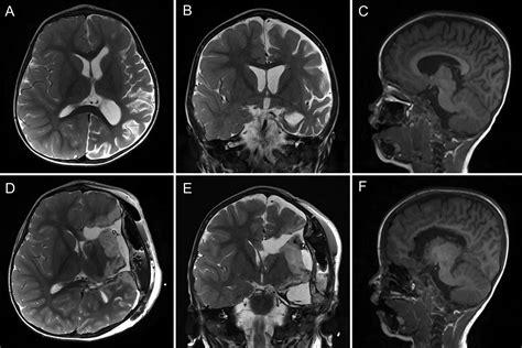 Pediatric functional hemispherectomy: operative techniques and ...