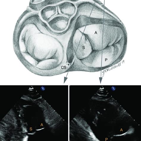 Transthoracic echocardiography of the tricuspid valve in the... | Download Scientific Diagram