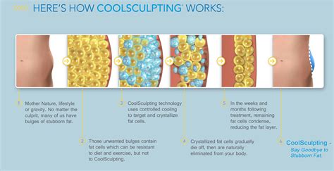 CoolSculpting Cost 2020: Price, Reviews, Side Effects, Before And After ...