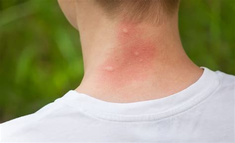 What Do Dust Mite Bites Look Like? Check Signs And Symptoms Here