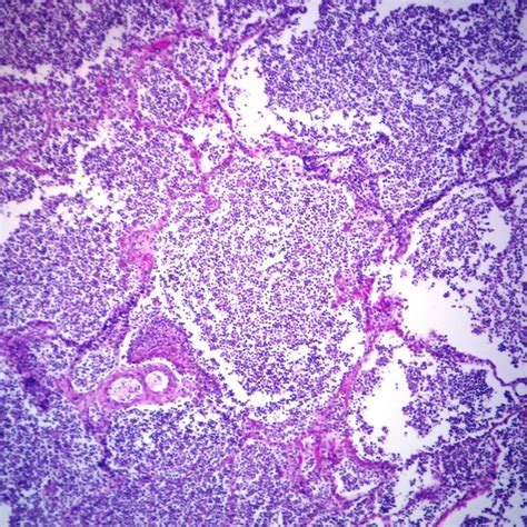 Lobar Pneumonia Histology