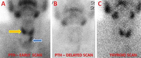 Parathyroid adenoma with rapid washout on a dual-phase sestamibi scan