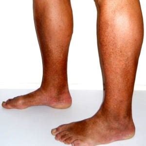 Operation better than exercise for poor leg circulation | Health24