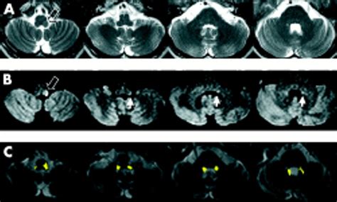 Cerebral Peduncle Mri