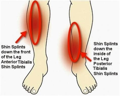 Part 2: Bone related shin splints: A right pain in the……SHIN!