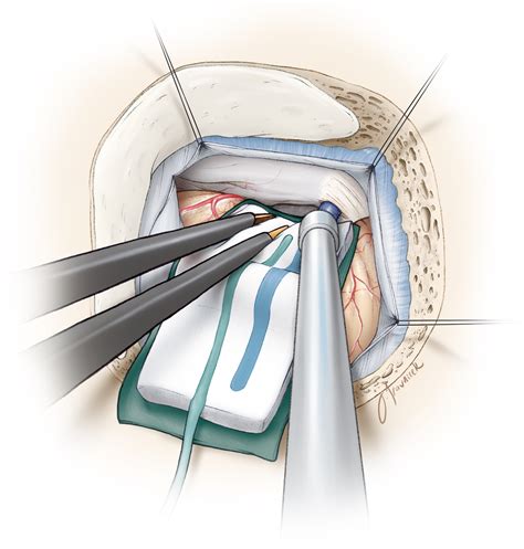 Microvascular Decompression for Trigeminal Neuralgia | The Neurosurgical Atlas