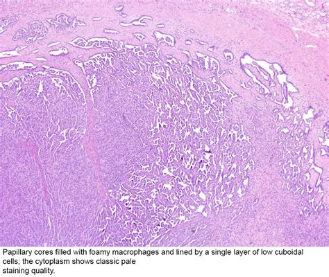 Pathology Outlines - Papillary type 1