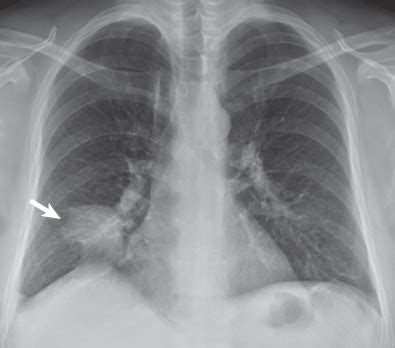 Consolidation | Radiology Key