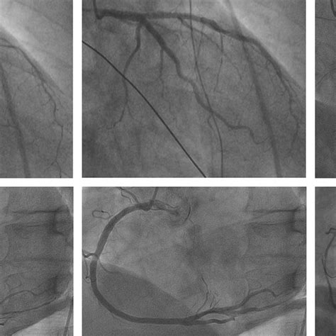 Coronary angiography. Left panels (case 1): coronary vasospasm in... | Download Scientific Diagram