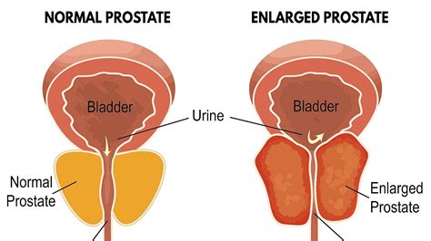 Enlarged Prostate Surgery Side Effects - Effect Choices