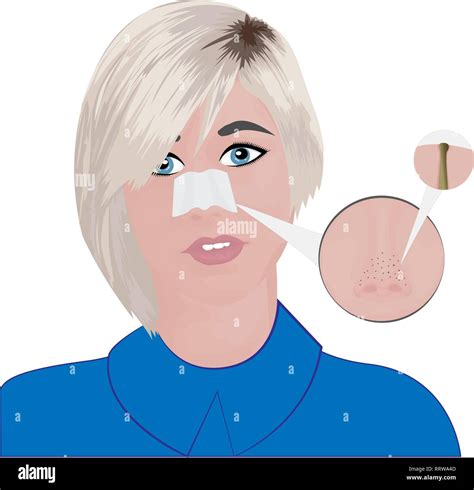 Treatment Blackheads on Nose vector illustration showing skin problems Stock Vector Image & Art ...