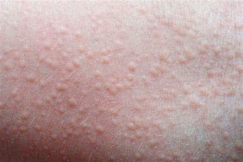 Heat Rash: Causes, Symptoms, Treatment and Prevention