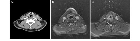 Extracapsular spread of tumor on CT and MRI. Contrast enhanced CT scan... | Download Scientific ...