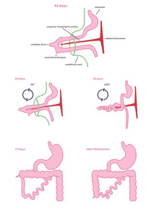 Volvulus Malrotation