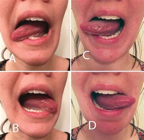 The Importance of Orofacial Myofunctional Therapy Before and After CO2 ...