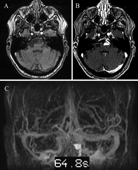 Brain Aneurysm Mri : 4 Intracranial Aneurysms Radiology Key - A brain aneurysm can result from a ...