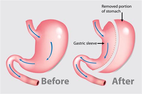 Bariatric Surgery