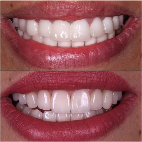 Emax Veneers - Beautiful Smiles in Birmingham