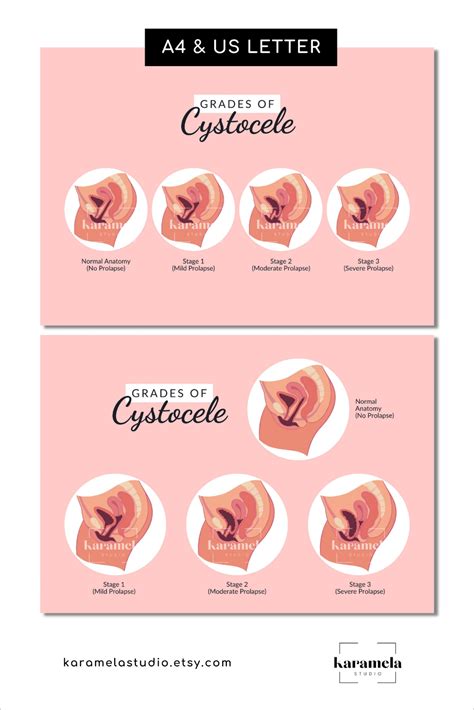 Printable Diagram of Cystocele Grading Stages of Cystocele - Etsy UK in ...