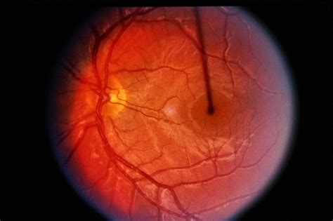 DUSN / Optic Papillitis - Retina Image Bank