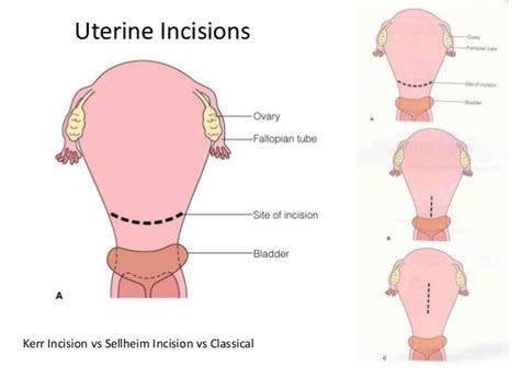 Modern Approach to The Cesarean Section Technique