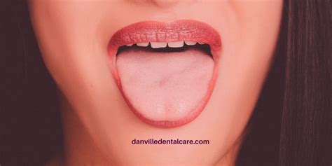 Salivary Gland Stones: What are they and How are They Treated? - Danville Family Dentistry