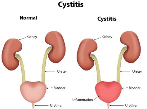 What is Cystitis and what causes it - Bansal Global Hospital