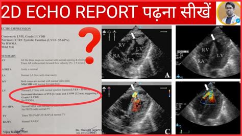 2D ECHO REPORT कैसे पढ़ते हैं/2D ECHO REPORT मैं क्या क्या लिखा होता है ...